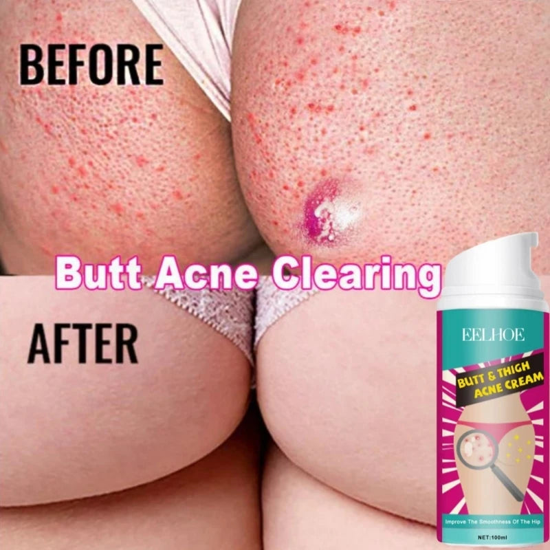 100ml Butt Thigh Face Acne Treatment Cream Repair Pimple Spots Bumps Skin Deep Cleaning Pore Clog Whiten Moisturizer Body Lotion