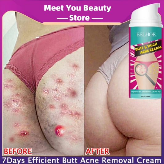 100ml Butt Thigh Face Acne Treatment Cream Repair Pimple Spots Bumps Skin Deep Cleaning Pore Clog Whiten Moisturizer Body Lotion