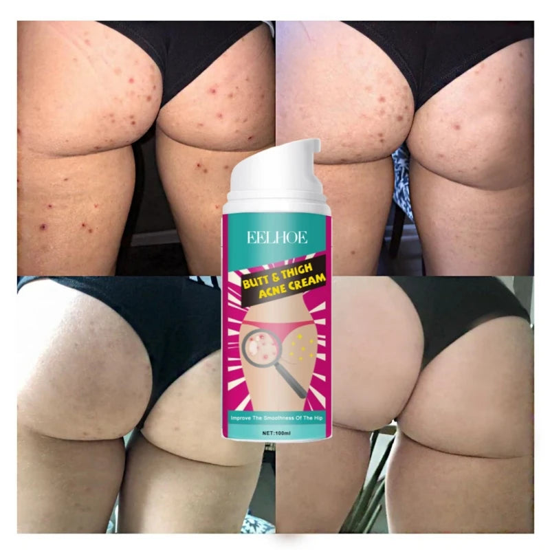 100ml Butt Thigh Face Acne Treatment Cream Repair Pimple Spots Bumps Skin Deep Cleaning Pore Clog Whiten Moisturizer Body Lotion